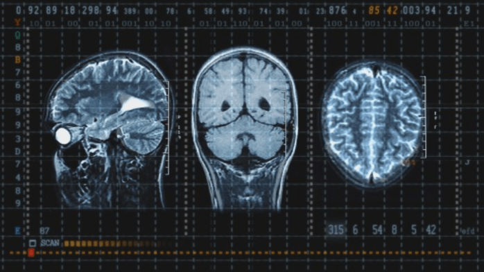 Reflections on International Consensus Statements on Concussion in&nbsp;Sport